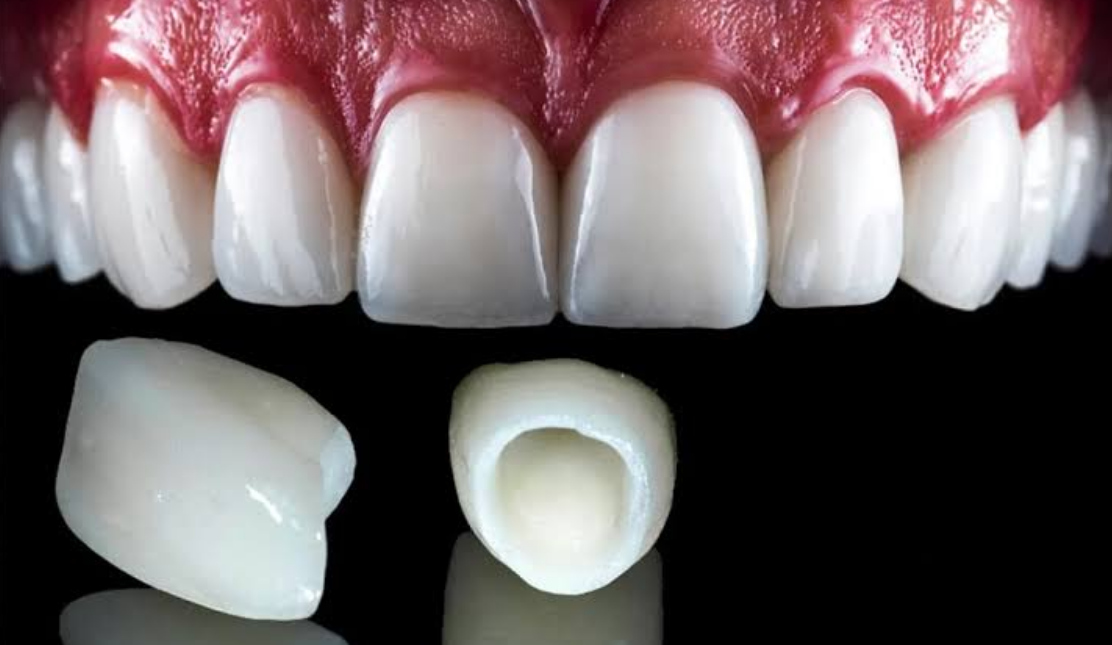 تفاوت لمینت و روکش دندان؛ هرکدام برای چه شرایطی مناسب هستند؟
