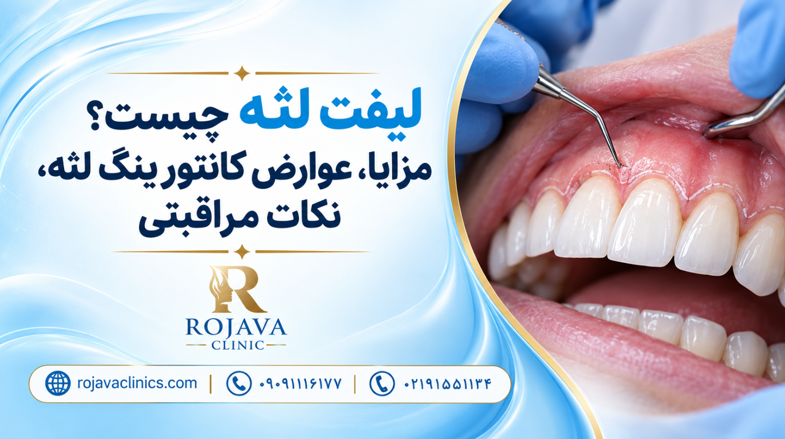 لیفت لثه چه کاربردی دارد؟